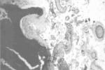 病毒性腦膜炎 病毒性腦炎 散發性腦炎
