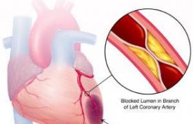 腦血管硬化 Cerebral Atherosclerosis