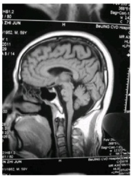 腦幹梗塞 I63.801 The brain stem infarction