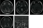 腦幹梗塞 I63.801 The brain stem infarction