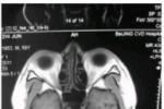 腦幹梗塞 I63.801 The brain stem infarction