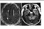 腦幹梗塞 I63.801 The brain stem infarction