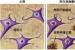阿爾茨海默病 老年性癡呆 老年癡呆 AD