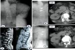 脊髓損傷 T09.302 Spinal cord injury