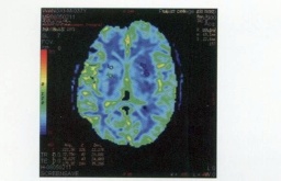 腔隙性腦梗死 腔隙梗塞