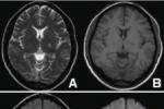 腔隙性腦梗死 腔隙梗塞