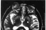 腔隙性腦梗死 腔隙梗塞