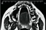 脊髓空洞癥 G95.001 syringomyelia