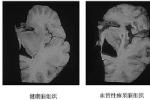 癡呆 智能減退