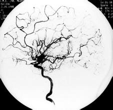 腦血管病 I67.903 腦血管疾病 CVD