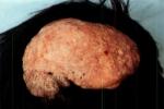 結節性硬化癥 結節性腦硬化 結節性硬化病