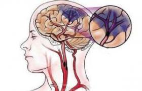 缺血性腦卒中 中風 卒中 腦梗死