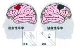 缺血性腦卒中 中風 卒中 腦梗死