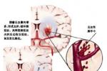 缺血性腦卒中 中風 卒中 腦梗死