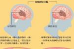 缺血性腦卒中 中風 卒中 腦梗死