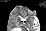 腦膿腫 G06.006 顱腦癰 大腦膿腫