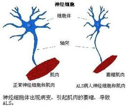 肌萎縮側索硬化癥 漸凍人癥