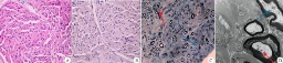 腓骨肌萎縮癥 遺傳性運動感覺神經病 Charcot-Marie-Tooth綜合征