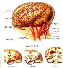 巨腦回畸形 兒童巨腦綜合征 兒童期巨腦畸形綜合征