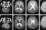 脊髓小腦性共濟失調 Spinal cord cerebellar ataxia Spinal cord cerebellar ataxia