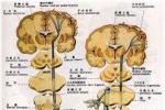 脊髓小腦性共濟失調 Spinal cord cerebellar ataxia Spinal cord cerebellar ataxia
