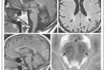 脊髓小腦性共濟失調 Spinal cord cerebellar ataxia Spinal cord cerebellar ataxia