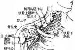 臂叢神經痛 痹證 筋痹 肩臂痛