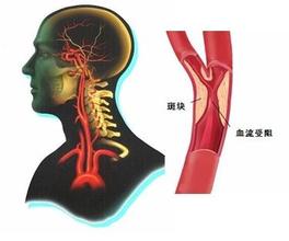 腦動脈硬化癥 腦動脈硬化 腦絡痹