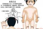 高熱驚厥 發熱性驚厥 發熱抽搐