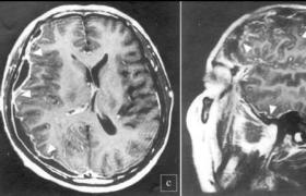 小兒化膿性腦膜炎 新生兒化腦 新生兒細菌性腦膜 新生兒腦膜炎