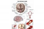 腦血管疾病 腦中風 腦血管意外 腦卒中