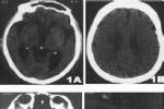 賓斯旺格病 賓斯旺格氏病 動脈硬化性皮層下腦病 進行性白質腦病 皮質下動脈硬化性腦病
