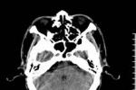 出血性腦梗死 出血性梗塞形成 腦梗死後腦出血