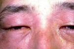 眼瞼痙攣-口下頦部肌張力障礙 Meige綜合征 Brueghel綜合征