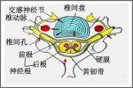 脊髓壓迫癥 脊髓壓迫 compressivemyelopathy