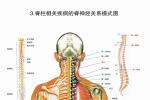 脊髓壓迫癥 脊髓壓迫 compressivemyelopathy