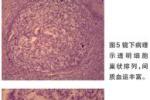 脊柱轉移癌