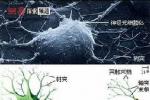 多發性末梢神經炎 Multiple peripheral neuritis 末梢神經炎
