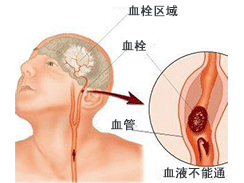 腦血栓 腦血栓形成 血栓性腦梗死
