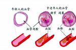 腦血栓 腦血栓形成 血栓性腦梗死