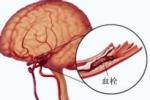腦血栓 腦血栓形成 血栓性腦梗死