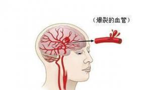 腦出血 I61.902 腦溢血 高血壓性腦出血 cerebral hemorrhage