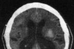 腦出血 I61.902 腦溢血 高血壓性腦出血 cerebral hemorrhage