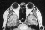 腦出血 I61.902 腦溢血 高血壓性腦出血 cerebral hemorrhage