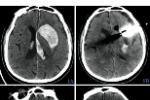腦出血 I61.902 腦溢血 高血壓性腦出血 cerebral hemorrhage