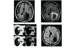 腦瘤 顱內腫瘤 腦腫瘤