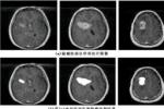 腦瘤 顱內腫瘤 腦腫瘤