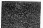 腦水腫 G93.601 Brain edema