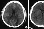 腦水腫 G93.601 Brain edema