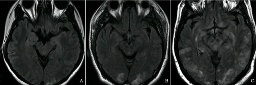 腦水腫 G93.601 Brain edema